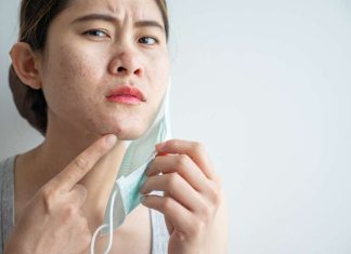 5 Arti Letak Jerawat dan Penyebabnya
