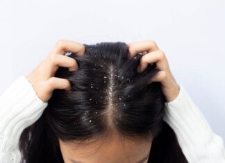 5 Cara Merawat Kulit Kepala dan Rambut Bebas Ketombe di Musim Hujan