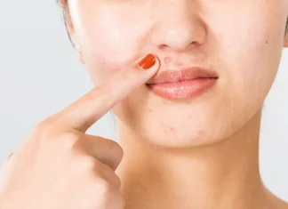 Catat! Penyebab dan Cara Mengatasi Jerawat di Area Bibir dan Dagu