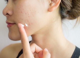 Catat! 4 Bahan Skincare yang Wajib Dihindari Saat Kulit Sedang Berjerawat