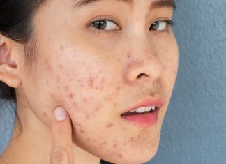 Kenali Jenis Bopeng dan Acne Scars pada Wajah serta Cara Mengatasinya!