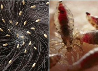 Sederetan Cara Menghilangkan Kutu Rambut dengan Cepat